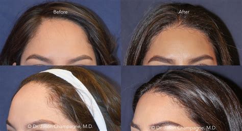 common insecurities   fix  receding hairline plastic surgeon