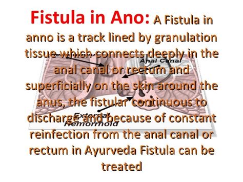 Piles fissures fistula