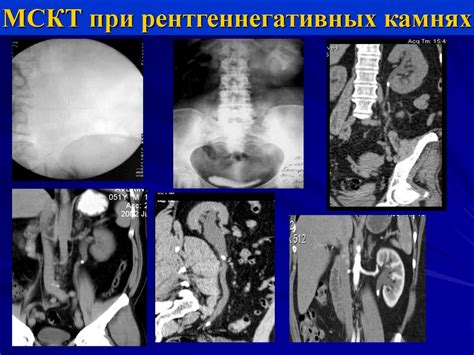 Мочекаменная болезнь - презентация онлайн
