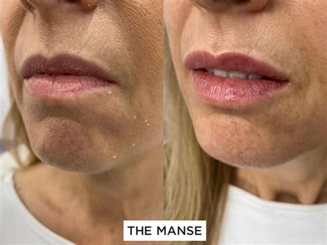 best wrinkle line filler 6