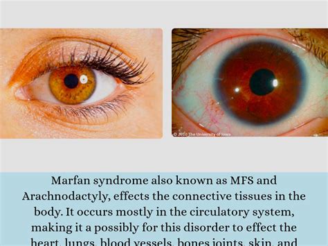 Marfan syndrome eye symptoms – Prnso