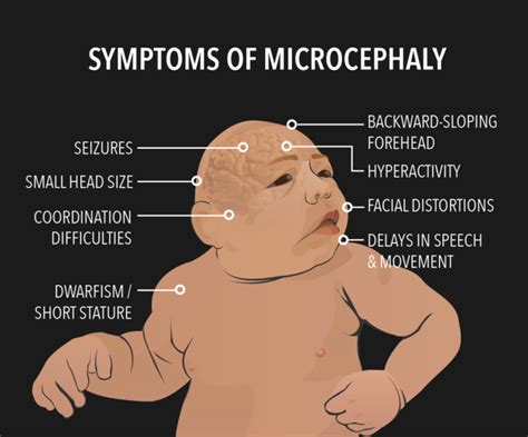MICROCEPHALY | Dr. Simon Says Science (And More)
