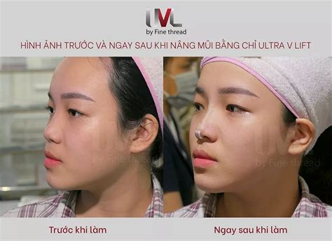 Ứng dụng của chỉ Hiko Short