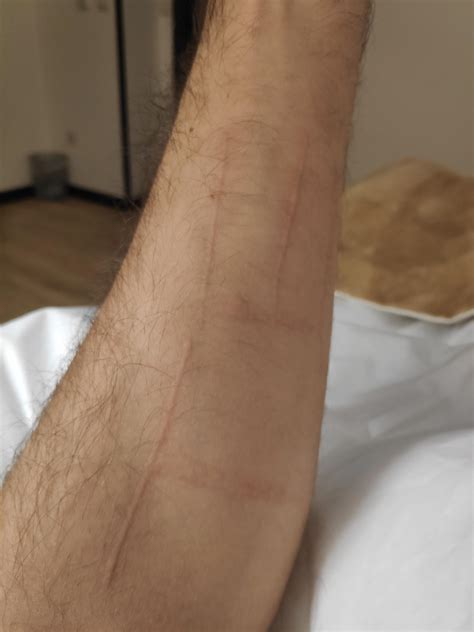 43 best r/dermatographia images on Pholder | Getting tattooed with this