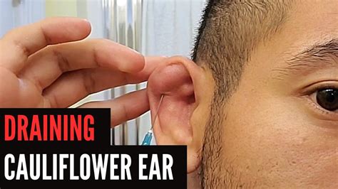 Cauliflower Ear Gym at Bobby Flores blog