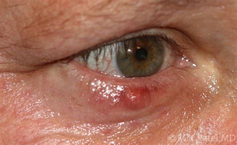 Moran CORE | What is a chalazion and how do you treat it? The many ...