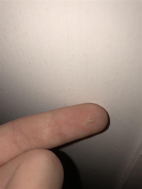 Popped this out of my taint area. (SFW) : r/popping