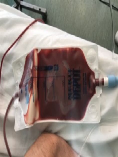 disappearance   cyst  successful transdermal drainage