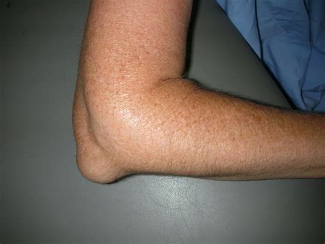 althab jrab almrfk elbow olecranon bursitis aldktor mazn krdy