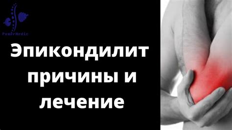 ЭПИКОНДИЛИТ ЛОКТЕВОГО СУСТАВА - Причина и Лечение - YouTube