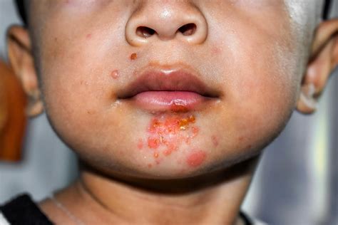 Impetigo: Symptoms, Causes, Complications, and Treatments