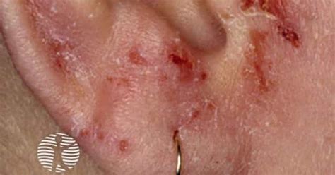 Atopic dermatitis image