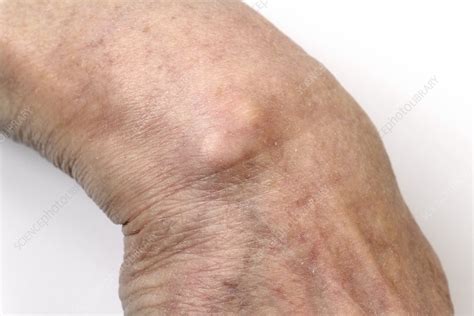 ganglion cyst  wrist bone ganglion cyst fact sheets yale