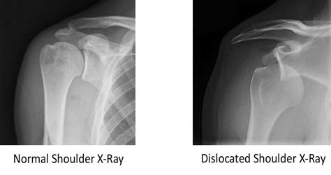 Shoulder Dislocation - DOCJOINTS//DR SUJIT JOS//Joint Surgeon for Knee ...
