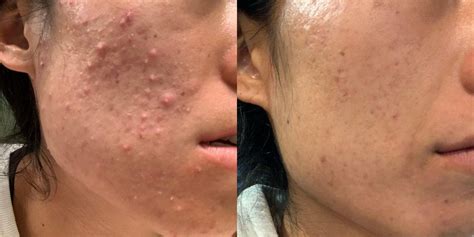 Before & After HydraFacial - Berman Skin Institute