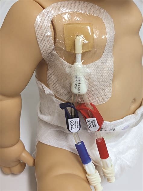 Haemodialysis Line (Permcath) - Leeds Teaching Hospitals NHS Trust