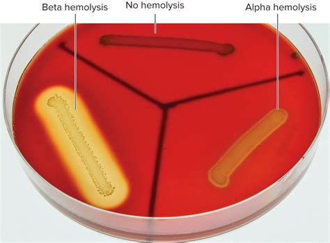 beta hemolysis  blood  kingstongromelton
