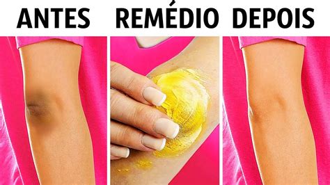 Como Clarear O Cotovelo - 10 Truques Naturais Para Clarear Os Joelhos e Cotovelos - YouTube
