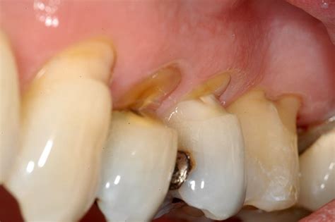 Tooth Abfraction Treatment