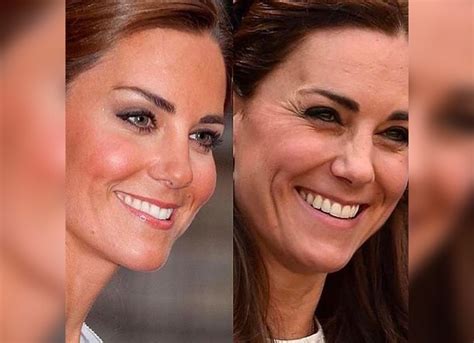 Kate Middleton Plastic Surgery: Expert Thoughts And Her Response