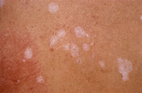 Lichen sclerosus - Huidhuis