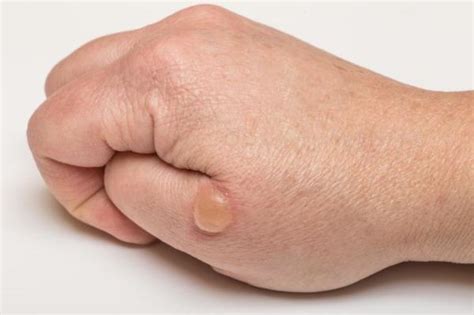 Bolhas De Água Na Pele Que Coçam E Viram Feridas - Bolhas de água na pele: causas e como curá-las - RÁPIDO E SEM MARCAS!
