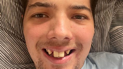 Fundraiser by Brandon Beavis : Help me (Beavo) fix my teeth