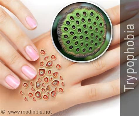 holes  skin disease