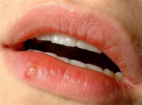 How to Get Rid of Fever Blisters