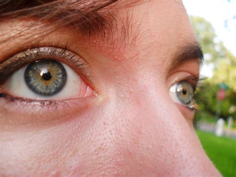 Central Heterochromia: A Rare and Beautiful Eye Color