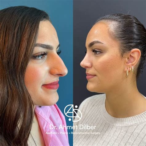 untitled  shape   nose tells  ton   nose job