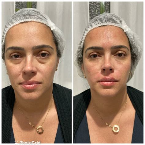 Botox Levanta O Olhar