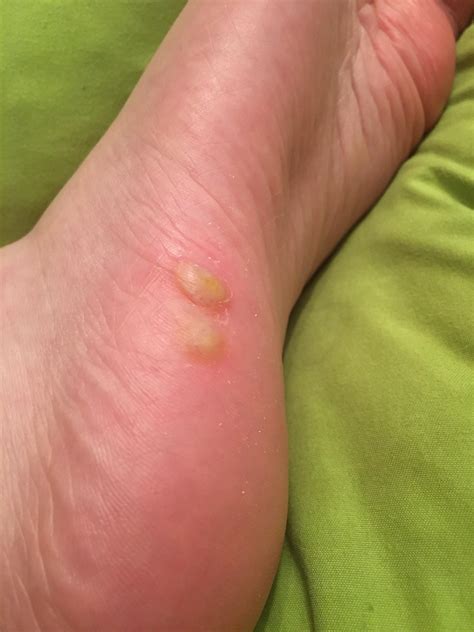 These warts were small and not very visible, when I started to treat
