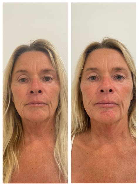 jaw filler la belle clinic