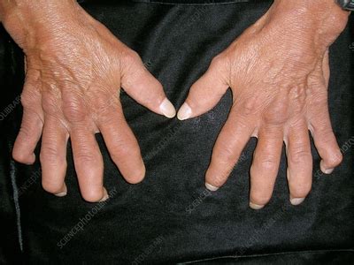 CREST syndrome - Stock Image - C056/1115 - Science Photo Library