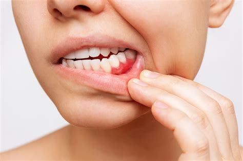 Periodontal Disease - Causes & Treatments - Forestside Dental Practice