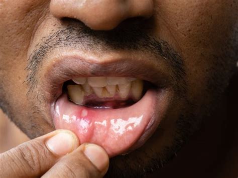 Home Remedies for Painful Tongue Ulcers - TV Health