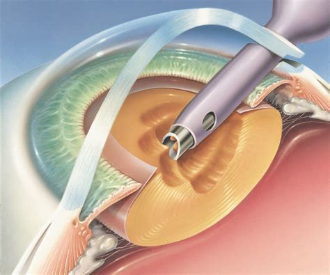 Cataract Surgery Procedure Guidelines