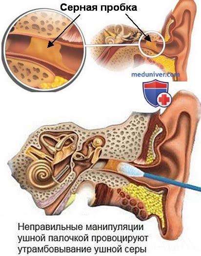 Серная пробка. Клиника и прогноз серной пробки