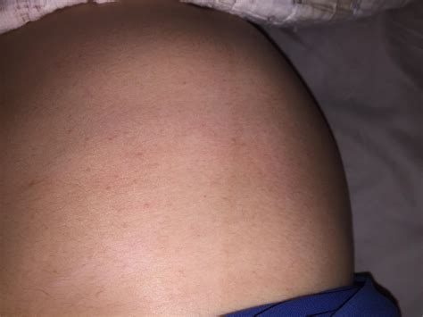 Not sure if you can see but I'm very itchy and I'm starting to get