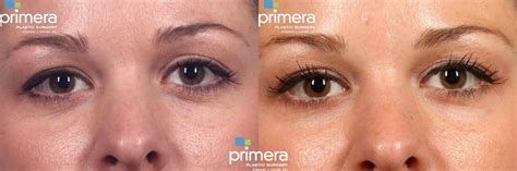 LATISSE® Before and After Photo Gallery | Orlando, Florida | Primera ...
