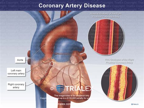 coronary artery disease trialquest