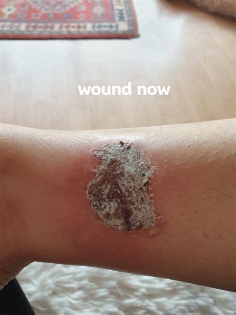 white scab  wound rwoundcare