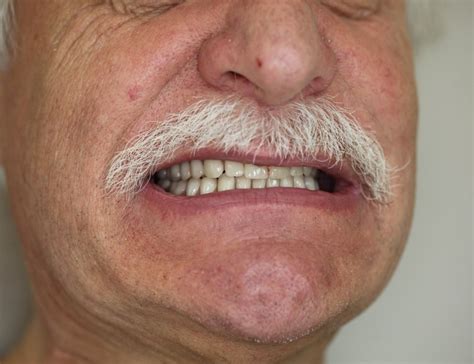 Temporary dentures