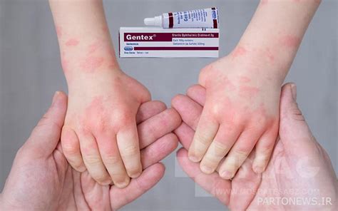 What is Gentamicin ointment? - پرتو نیوز