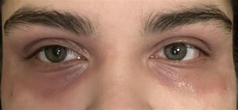 Help with “bruised” skin around eye : r/SkincareAddicts