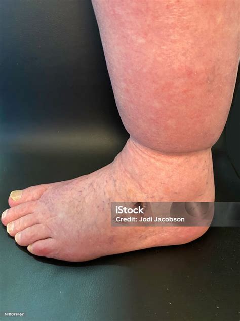 Leg With Edema Stock Photo - Download Image Now - Foot, Leg, Edema - iStock