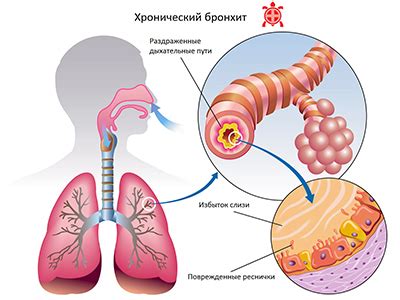 Бронхит. Причины. Диагностика. Лечение. | Клиника Здоровья