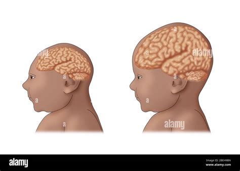 Microcephaly, Illustration Stock Photo - Alamy