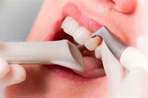 Професійне чищення зубів - Стоматологічна клініка "DentalWood"
